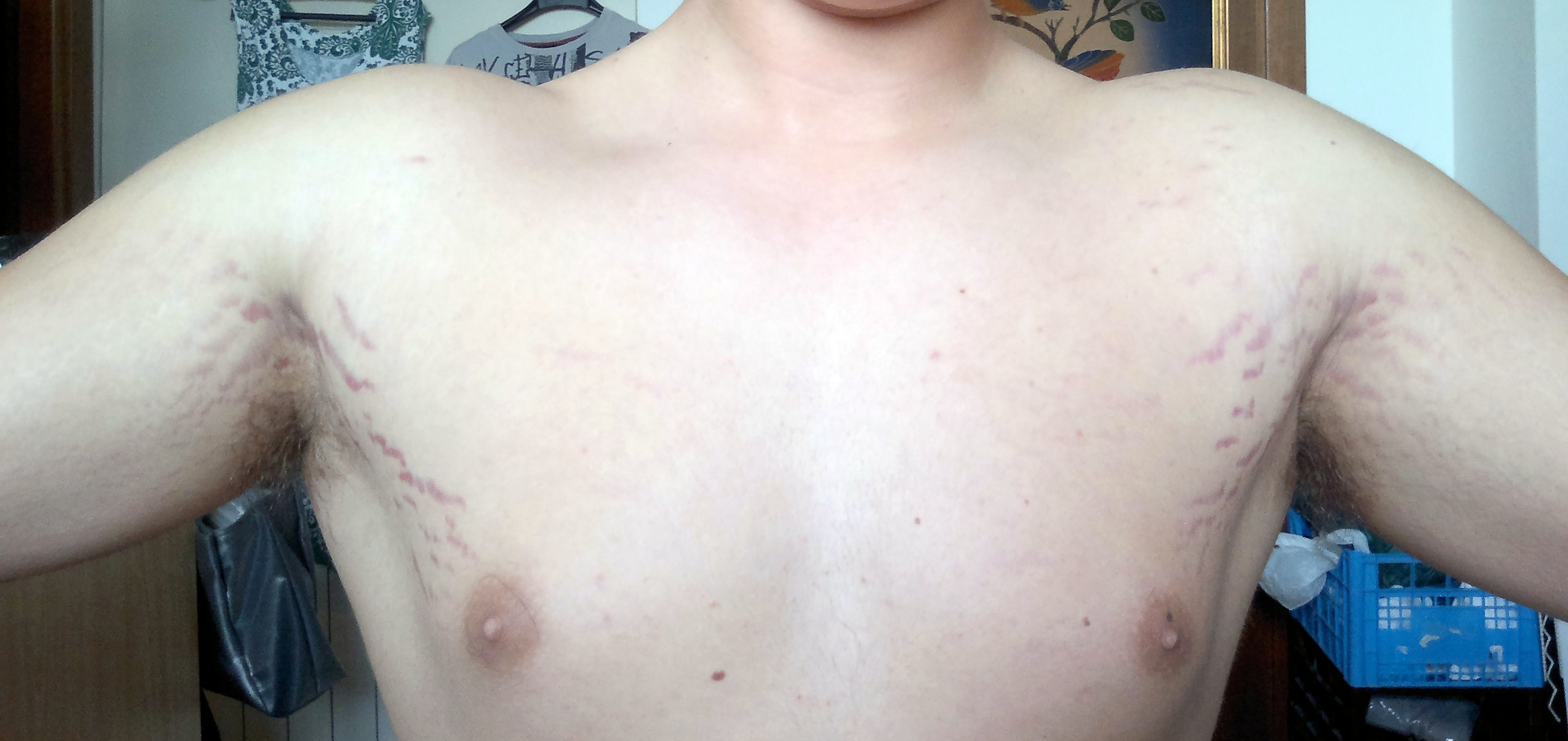 растяжки на груди мужчин фото 10