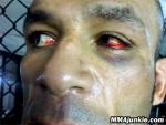 mostapha_al_turk_picture_injured_eye.jpg