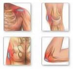 bursitis.jpg